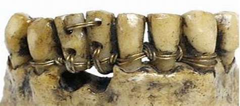dientes con alambres | Medievallink